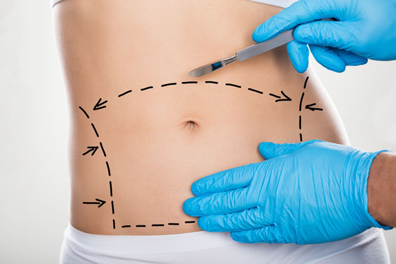 Abdominoplastik Amberg